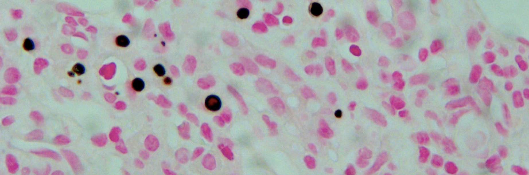 Malakoplakie rénale : une cause rare d’infiltration rénale pseudotumorale